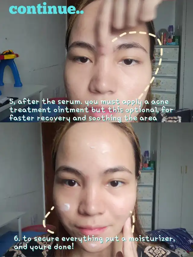 what are you gonna do after the acne pop-out?