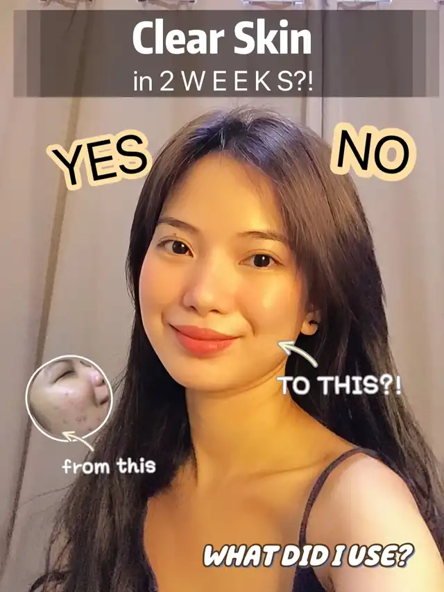 CLEAR SKIN ONLY IN 2 WEEKS?!