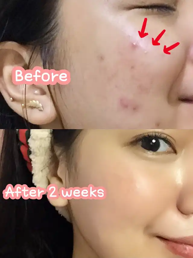 CLEAR SKIN ONLY IN 2 WEEKS?!