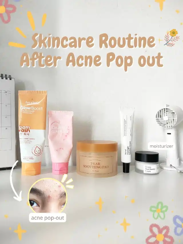 what are you gonna do after the acne pop-out?